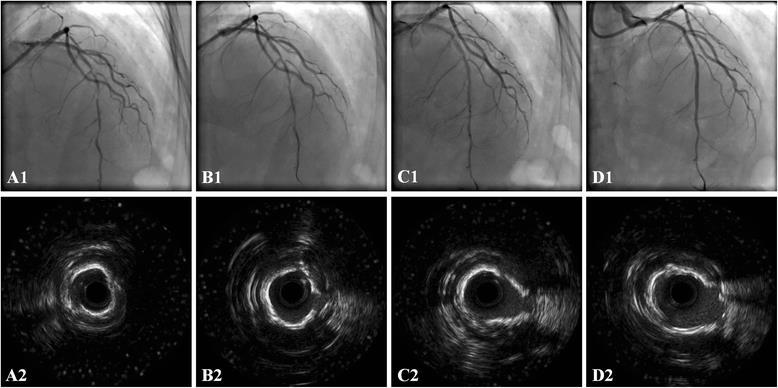 Intensive plaque modification with rotational atherectomy and cutting balloon before drug-eluting stent implantation for patients with severely