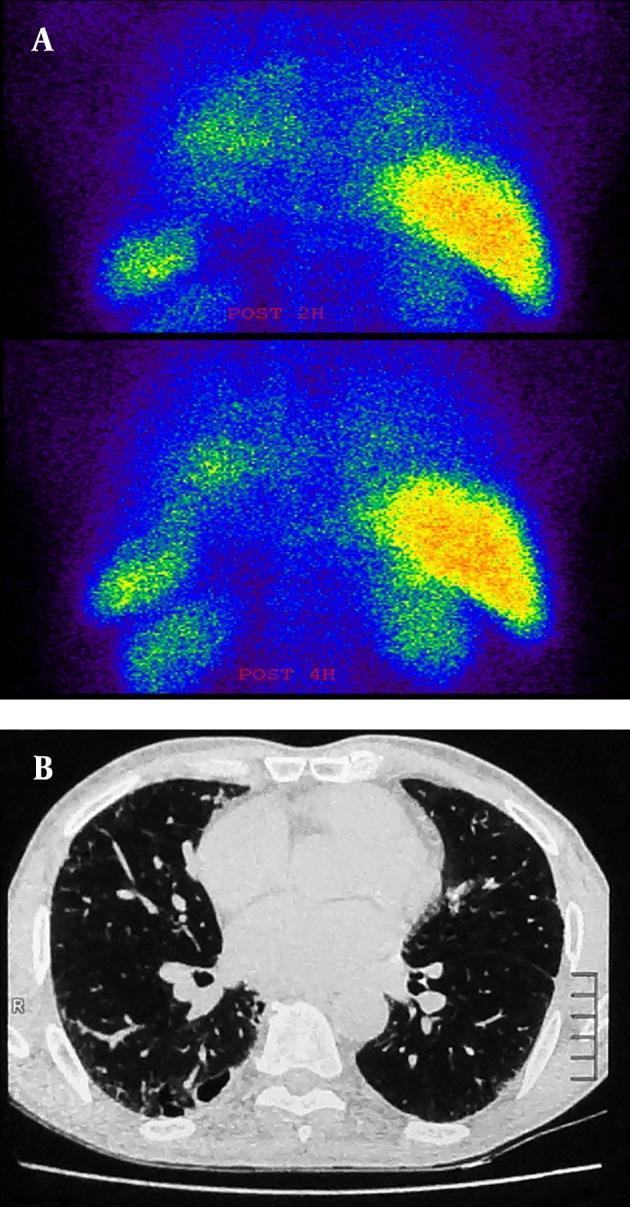 Σπινθηρογράφημα με 99mTc-IgG Ασθενής με διάμεση πνευμονοπάθεια Σημαντική συγκέντρωση του ραδιοφαρμάκου στα πνευμονικά πεδία στις πρώιμες λήψεις, η οποία διατηρείται στις 4h Αξονική τομογραφία υψηλής