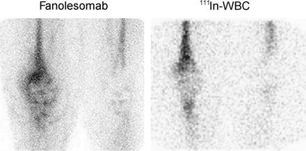 Λοίμωξη αρθροπλαστικής ΑΡ γόνατος (ΑΡ) Fanolesomab (2h) (ΔΕ) Επισημασμένα λευκοκύτταρα (24h) Source: