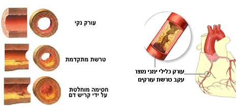 בעורקים אחרים בגוף, אלא שבעורקים האחרים ההפרעות לזרימת הדם אינן משפיעות באופן כה קיצוני על תיפקוד הגוף, כפי שמשפיעה חסימה בעורקים הכליליים.