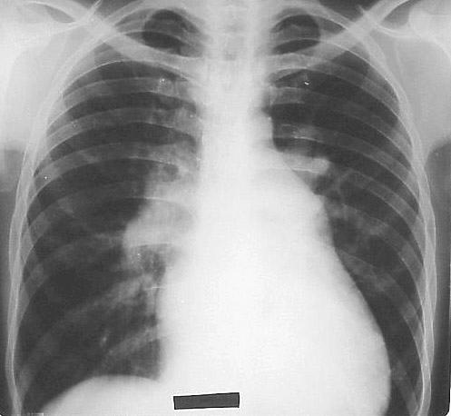 VSD (ventricular septal defect) Urođena srčana