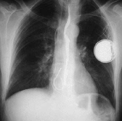 Pacemaker Implantiran ispod m.pectoralis maj. dex.