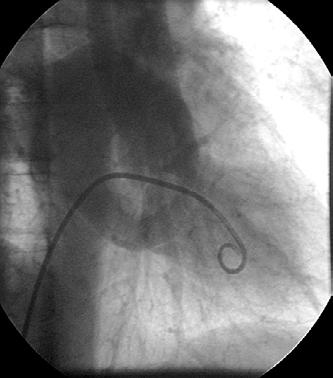 TU srca Benigni Miksom (1/2 benignih) najčešće u LV, na peteljci, mehanički