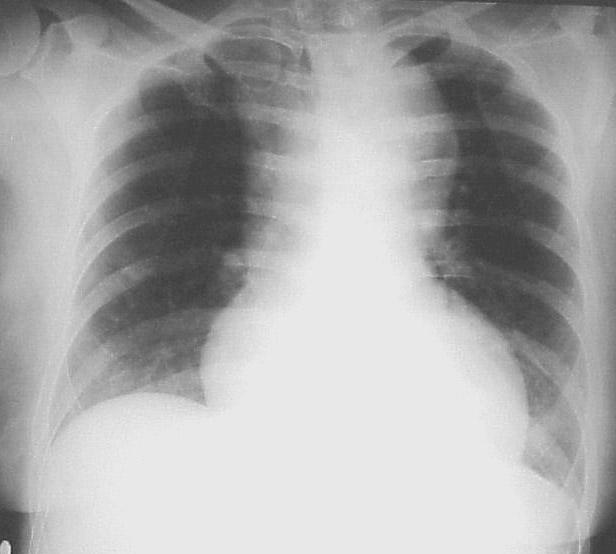 Aneurizme torakalne aorte Etiologija: aterosleroza, HTA, cistična medionekroza, sifilis, aortitis, trauma, dr.