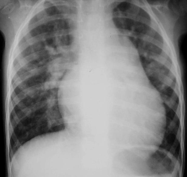 ASD (atrial septal defect) Urođena srčana mana, L-D šantom tip povećanog protoka,