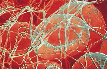 Αιματικός Θρόμβος Δίκτυο δοκίδων ινώδους κύτταρα του αίματος αιμοπετάλια πλάσμα Οι δοκίδες του ινώδους προσκολλώνται στις