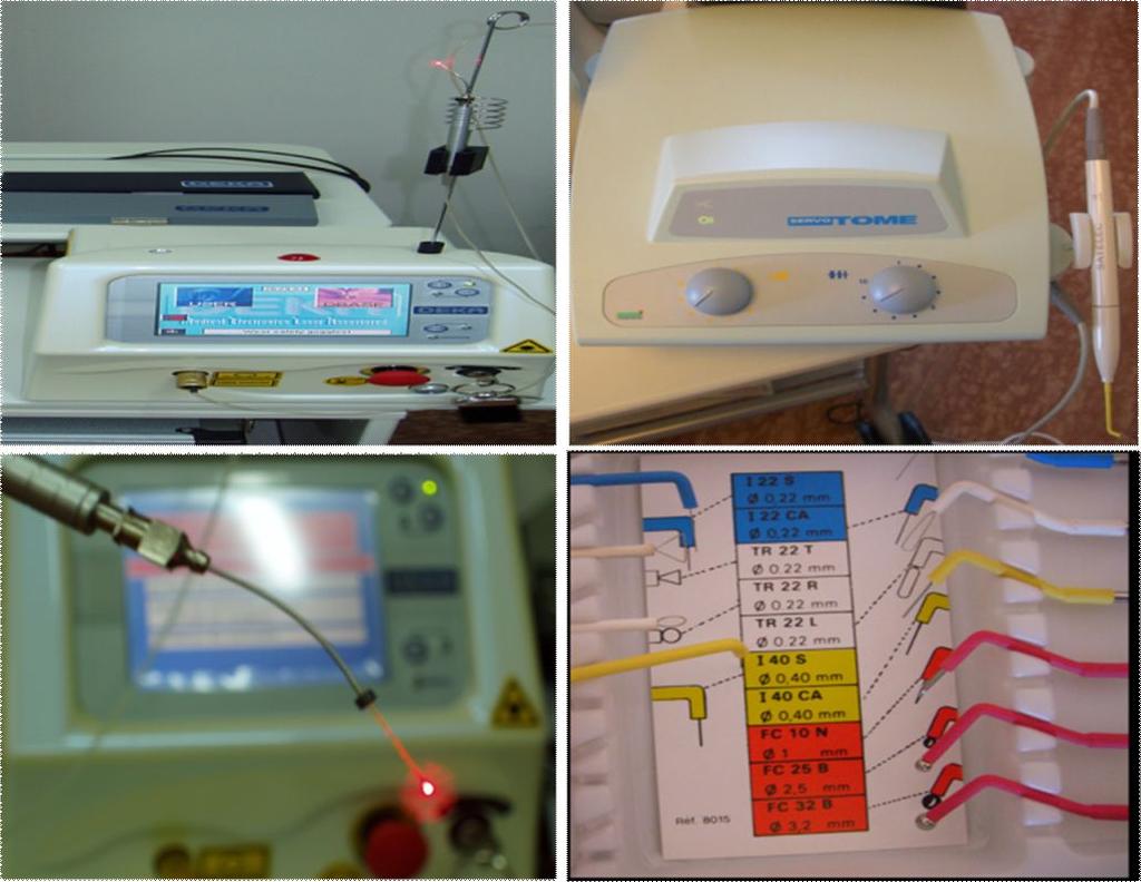 (Φωτ. 2), Διοδικό Laser (diode 980 nm), Ηλεκτροτόμος Η οπτική ίνα που οδηγεί την ακτίνα Laser ήταν διαμέτρου 300 μm και η κεφαλή του ηλεκτροτόμου είχε διάμετρο 0,40 mm. (φωτ.