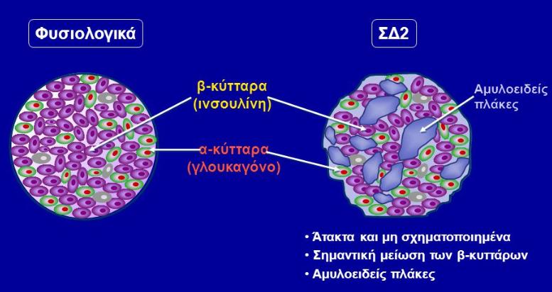 Παρόλο που τα ακριβή αίτια για την εμφάνιση Σακχαρώδους Διαβήτη Τύπου 2 δεν είναι ακόμη γνωστά, υπάρχουν αρκετοί παράγοντες κινδύνου.