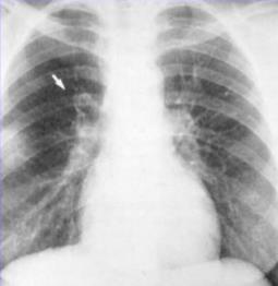 Westermark sign: dilatation of pulmonary vessels proximal to