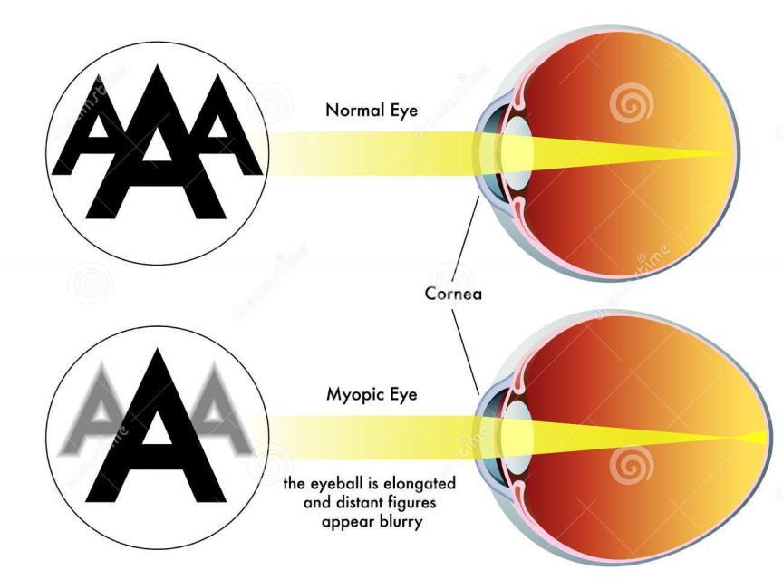 Το οπτικό σύστημα του οφθαλμού περιλαμβάνει μεγαλύτερη διαθλαστική ισχύ από αυτή που χρειάζεται ο οφθαλμός για το δεδομένο αξονικό μήκος του.