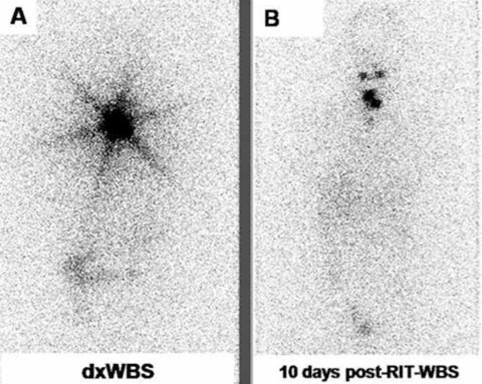 (A) 131I dxwbs (B) Μεταθεραπευτικό WBS Source: Etchebehere EC, et al.