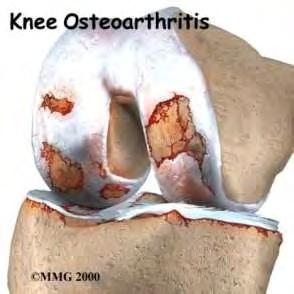 Εικ 4 Οστεοαρθρίτιδα γόνατος και ισχίου 4.3 ΑΙΤΙΟΛΟΓΙΑ Τα αίτια της οστεοαρθρίτιδας είναι πολλά.