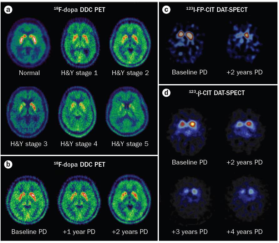 Νευροαπεικόνιση (DDC PET, SPECT ) και πρόοδος της νόσου του Πάρκινσον Μέση ετήσια ελάττωση της ντοπαμινεργικής χωρητικοτήτας