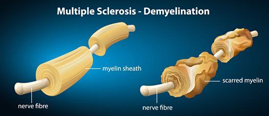 Πολλαπλή Σκλήρυνση: Φλεγμονή & Εκφύλιση Η Πολλαπλή Σκλήρυνση (Multiple sclerosis-ms) είναι μία από τις συχνότερες χρόνιες νευρολογικές παθήσεις η οποία πλήττει τους νεαρούς ενήλικες (20-40).