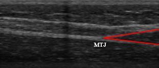 απόσταση της αλλαγής της θέσης της MTJ (εικόνα 4, 5) από την αρχική της θέση, και του μήκους του αχίλλειου τένοντα το οποίο υπολογίστηκε ως η απόσταση μεταξύ των ανακλαστήρων Β και Γ, και