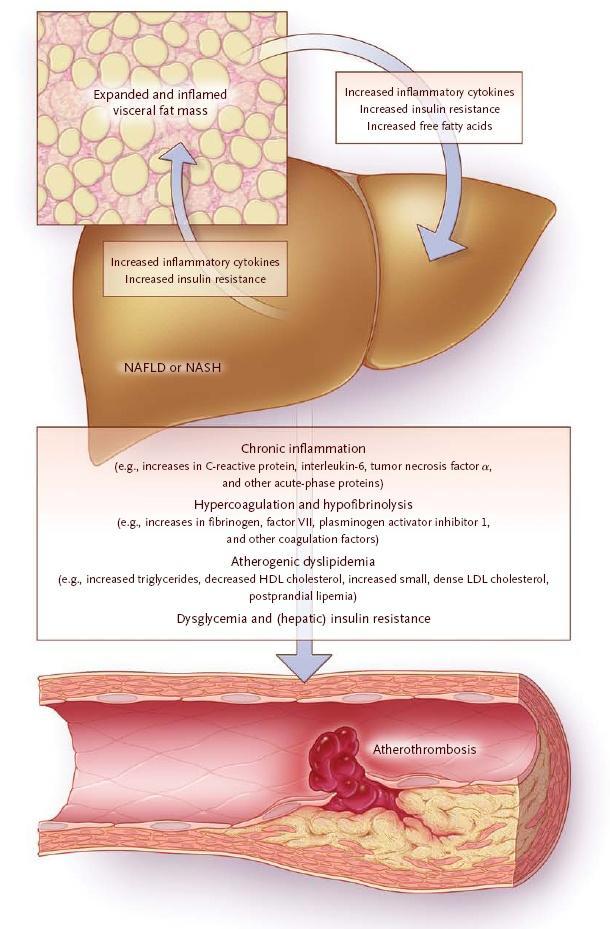 ΠΑΙΟΓΕΝΕΗ ΚΑΡΔΚΑΓΓΕΚΑΚΗ ΝΟΟΤ ΣΗΝ NAFLD Το λιπώδεσ και φλεγμαύνον όπαρ εκλύει ςτην ςυςτηματικό κυκλοφορύα προφλεγμονώδεισ κυτοκύνεσ (CRP, TNFα, IL6 κ.α.), προαιμοςτατικούσ παρϊγοντεσ (π.χ.