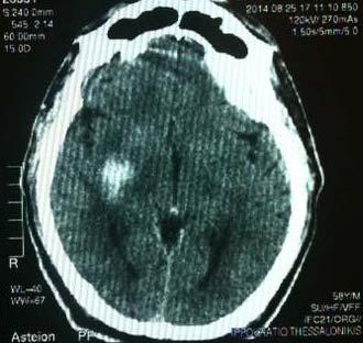 Διενέργεια 3 ης CT εγκεφάλου Παραμένει η γνωστή αιμορραγική εστία στα βασικά γάγγλια ΔΕ, χωρίς αξιόλογη μεταβολή ως προς τις διαστάσεις αυτής και το περιεστιακό οίδημα συγκριτικά με την προηγούμενη