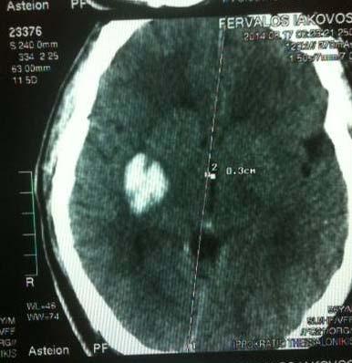 Διενεργείται CT εγκεφάλου Ευμεγέθης αιμορραγική εστία διαστάσεων 2,9x1,8 cm, με συνοδό περιεστιακό οίδημα, στα βασικά γάγγλια ΔΕ.