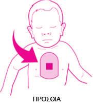 Pediatric-Pak Χρησιμοποιώντας το Pediatric-Pak Το Pediatric-Pak προορίζεται για παιδιατρικά θύματα (παιδιά) αιφνίδιας καρδιακής ανακοπής από