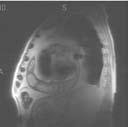 תמונה 8: בבדיקת Phase contrast מודגמת אי ספיקה של המסתם האאורטלי הביקוספידי בהיקף של כ- 20%.