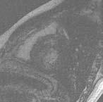 RVOT tachycardia טכניקת "האדרה מאוחרת" יכולה לעזור באפיון קרדיומיופתיה כאיסכמית או לא איסכמית Ischemic( )VS non ischemic cardiomyoapthy 20.