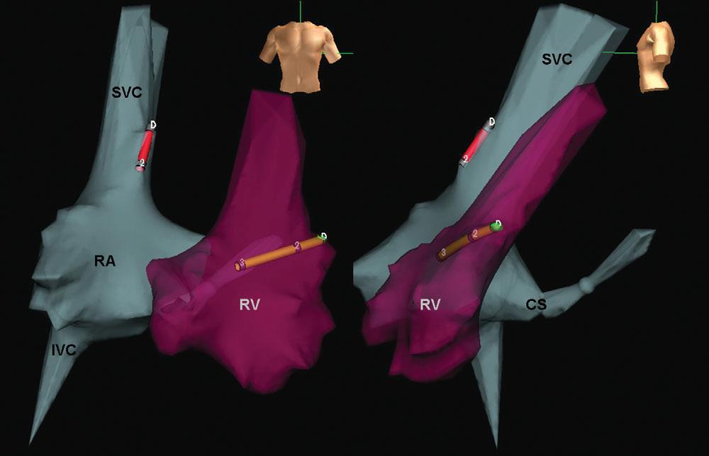 Dual-chamber implantable cardioverter defibrillator implantation guided by non-fluoroscopic