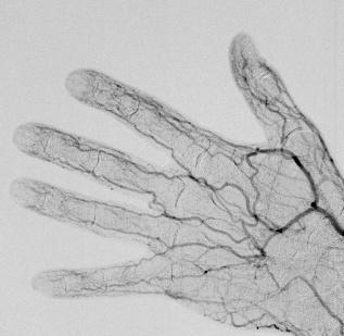 nephrotoxicity IV contrast