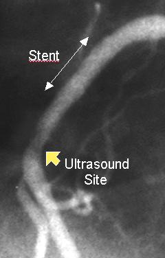 Stent