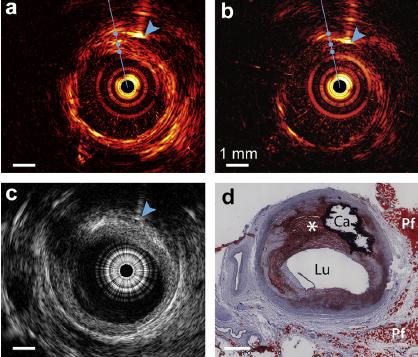 Intravascular Photoacoustic Imaging