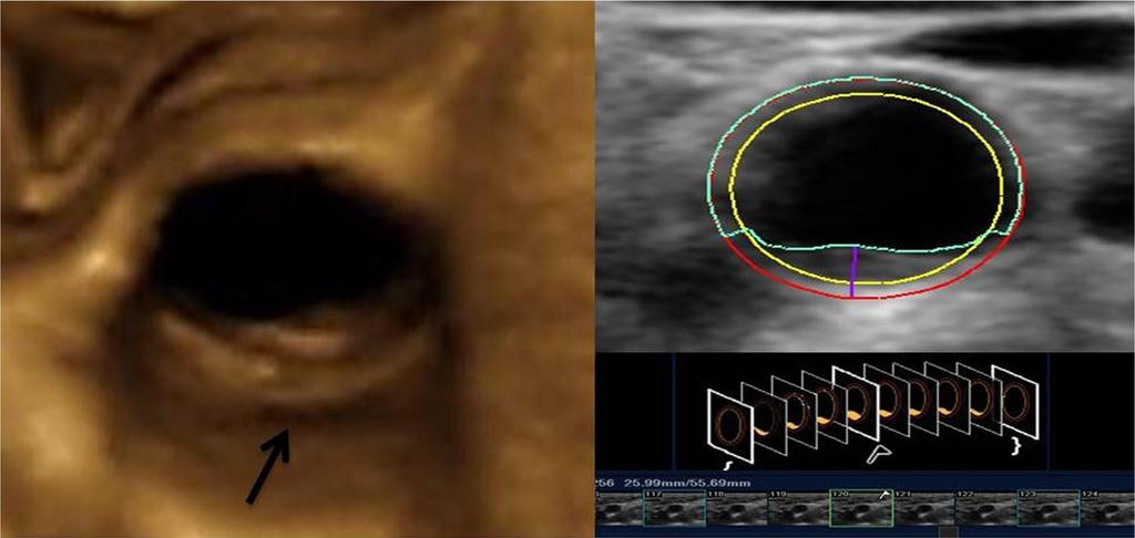 3D vascular ultrasound Αθηρωματική πλάκα