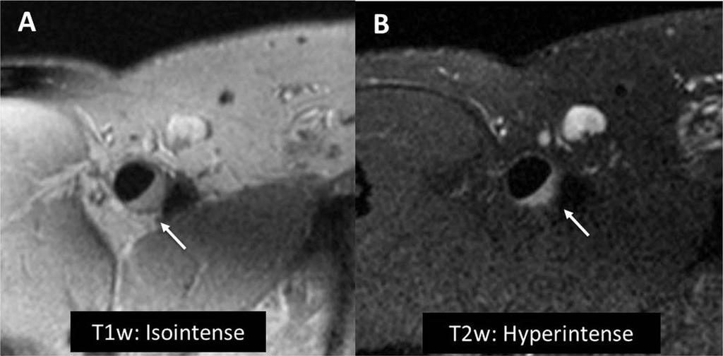 MRI Αρτηριοσκληρυντική