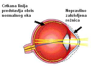 Astigmatizam: - Astigmatizam je anomalija vida koja nastaje kada je zakrivljenost rožnice nepravilna, što za