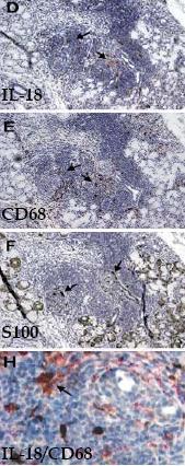 Interleukina 18 Exprimată de macrofage CD 68+ Creşterea expresiei se corelează cu : 1.