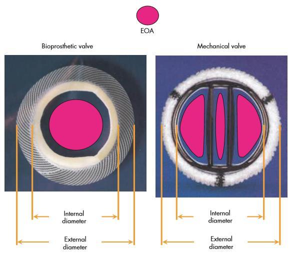 Effective Orifice Area (EOA) P.