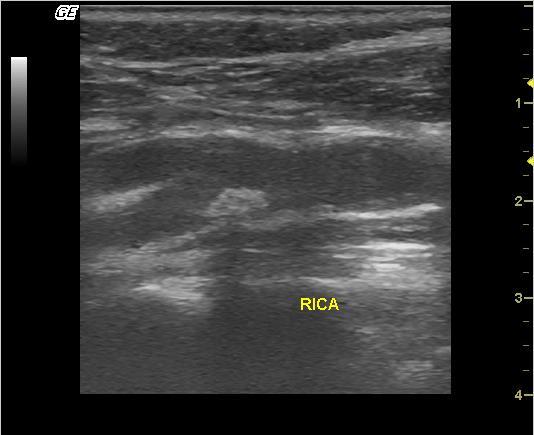 - LICA), δεξιά έσω καρωτιδική αρτηρία (Right internal carotid artery - RICA), και κοινή καρωτιδική αρτηρία (Common carotid artery CCA).