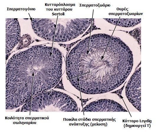 Ειςαγωγό Α) Β) χόμα 3. Α) Κϊθετη τομό του ϐρχεοσ, ϐπου διακρύνονται τα ςπερματικϊ ςωληνϊρια, τα κϑτταρα Sertoli και τα κϑτταρα Leydig. Β) Πορεύα ωρύμανςησ των ςπερματικϔν κυττϊρων. 3. ΝΕΟΠΛΑΙΑ ΣΨΝ ΟΡΦΕΨΝ Η νεοπλαςύα των ϐρχεων τυπικϊ αναπτϑςςεται ςε ϋναν απϐ τουσ δϑο ϐρχεισ του ϊνδρα.