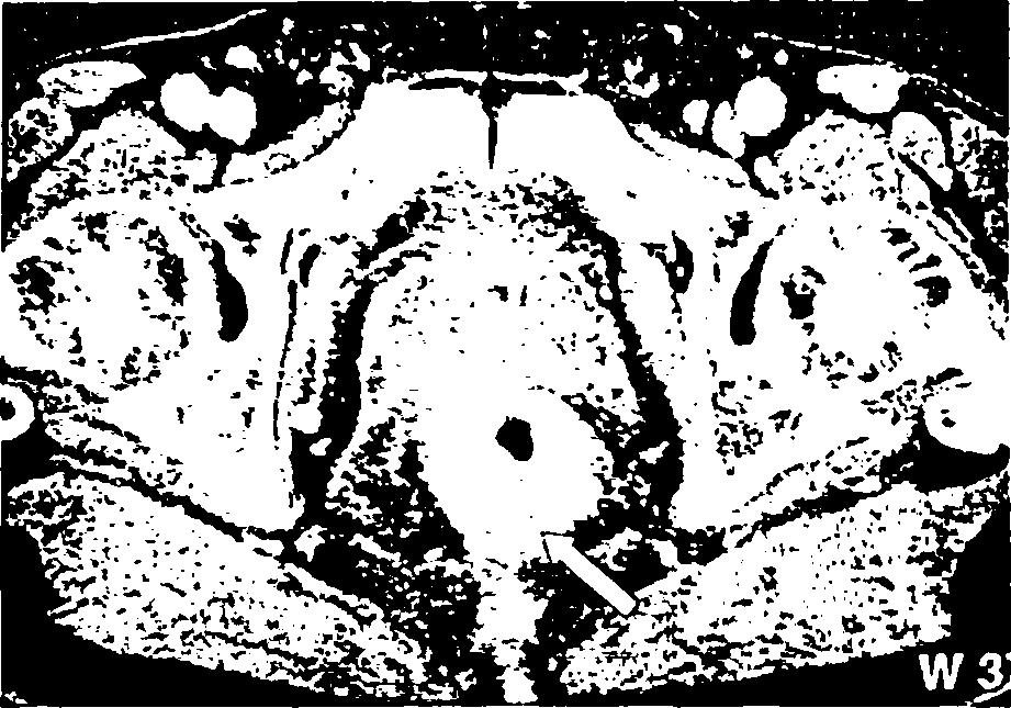 27 Εικόνα 4.2. CT πυέλου.
