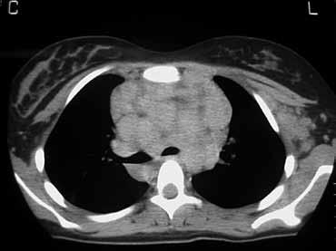 Εικόνα 6. Νόσος Hodgkin σε CT. Διογκωμένοι λεμφαδένες στο άνω μεσοθωράκιο και αριστεροί μασχαλιαίοι λεμφαδένες. Εικόνα 7. Λέμφωμα σε CT.