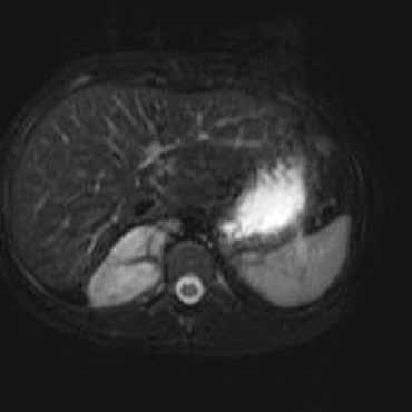 Α Β Εικόνα 14. Γαγγλιονεύρωμα σε παιδί ηλικίας 12 ετών. Α. MRI T2-HR ακολουθία, με καταστολή του σήματος του λίπους σε εγκάρσιο επίπεδο και Β.