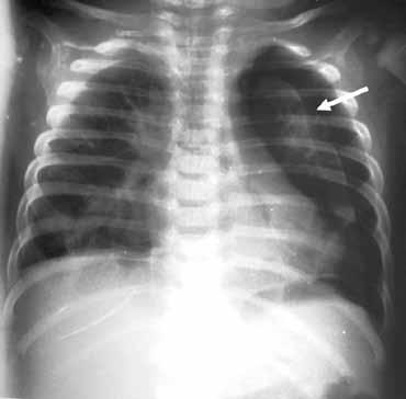 Εικόνα 15. Πνευμοθώρακας δεξιά σε αγόρι 12 ετών με ινοκυστική νόσο. Περιφερικά της γραμμής που παριστά τον περισπλάχνιο υπεζωκότα, (βέλη), δεν υπάρχουν πνευμονικά στοιχεία. Εικόνα 16.