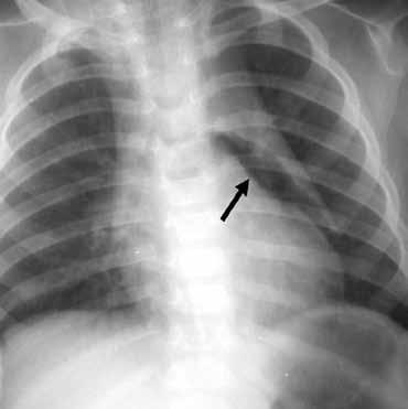 βρογχικό δένδρο. νισθεί και το έσω τμήμα του διαφράγματος (continuous diaphragm sign). 17 Η διάκριση του πνευμομεσοθωρακίου από πνευμοπερικάρδιο ή μεσοθωρακικό πνευμοθώρακα μπορεί να είναι δύσκολη.