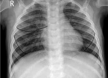 Ο αριστερός πνεύμονας αποτελείται από δύο λοβούς, τον άνω και τον κάτω, στους οποίους χωρίζεται με τη μείζονα μεσολόβιο σχισμή.