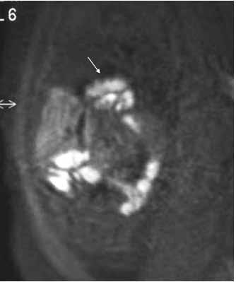 του ήπατος. Η διάγνωση της δεξιάς διαφραγματοκήλης στηρίζεται στην ενδοθωρακική θέση του ήπατος και την προς τα αριστερά απώθηση της καρδιάς (Εικόνες 2Α, 2Β).