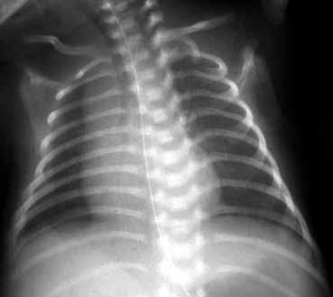 Απεικόνιση θώρακα νεογνού: Φυσιολογικός θώρακας - Χειρουργικά αίτια αναπνευστικής δυσχέρειας Χρ.
