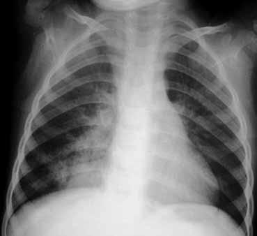 Πνευμονικό απόλυμα Το πνευμονικό απόλυμα (pulmonary sequestration) αποτελεί σπάνια συγγενή διαμαρτία που συνίσταται σε ανώμαλη, μη λειτουργική ανάπτυξη του πνευμονικού παρεγχύματος που διαχωρίζεται