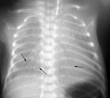 των πνευμονικών πεδίων και είναι εμφανέστερο σε ακτινογραφία σε φάση εισπνοής (Εικόνα 2).