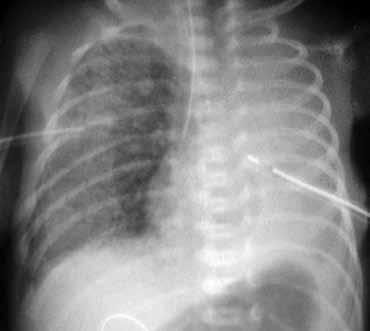 Εικόνα 6. Σύνδρομο αναπνευστικής δυσχέρειας. Πνευμονικό διάμεσο εμφύσημα και πνευμοθώρακας δεξιά. Εικόνα 7. Σύνδρομο αναπνευστικής δυσχέρειας. Παραμονή ανοικτού αρτηριακού πόρου.