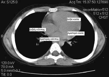 Θεσσαλονίκη: University Studio Press, 1989. 9. Kuhn JP. Pleura. In: Kuhn JP, Slovis TL, Haller JO, eds. Caffey s Pediatric X-ray Diagnosis, 10t