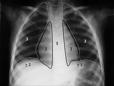 Πρότυπα ακτινολογικής βλάβης κατά την απεικόνιση του πνεύμονα Μ.Θ. Ραϊσάκη Ως πρότυπο ακτινολογικής βλάβης ορίζεται η αλλοίωση ή ο συνδυασμός αλλοιώσεων με τυπική ή ενδεικτική ακτινοσημειολογία.