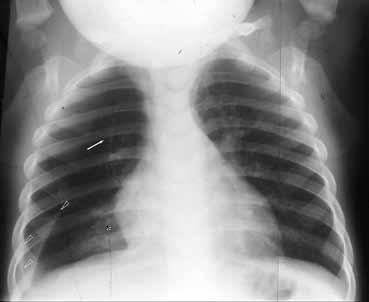 Χρειάζεται προσοχή να μην ερμηνευθεί ψευδώς ο πνευμοθώρακας υπό τάση σε κατακεκλιμένη ακτινογραφία ως υπερδιαυγαστικότητα παρεγχύματος με παγίδευση αέρα ή το αντίστροφο.